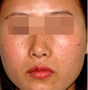 常见的激光、光子去晒斑