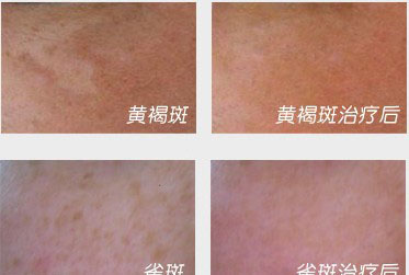 复合彩光轻松搞定脸上晒斑